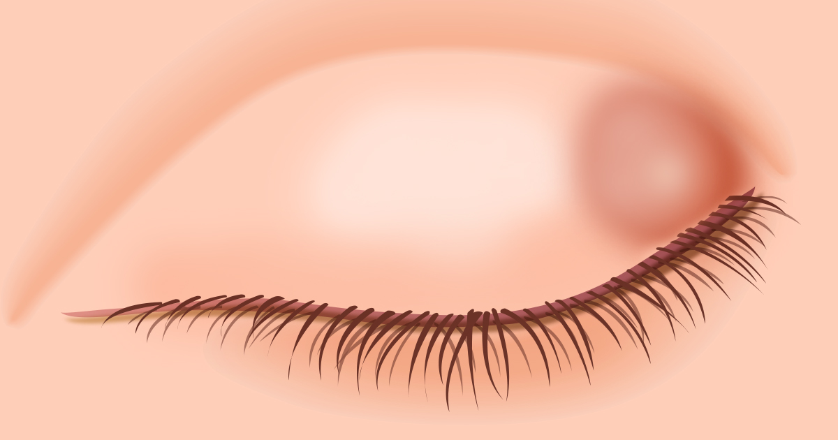 A common eyelid bump may be a chalazion.